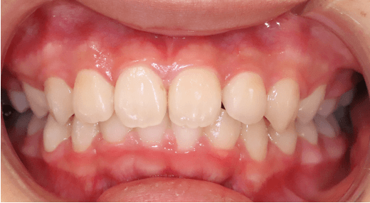 成人の過蓋咬合 ディープバイト さとみ矯正歯科 池袋 豊島区 矯正歯科